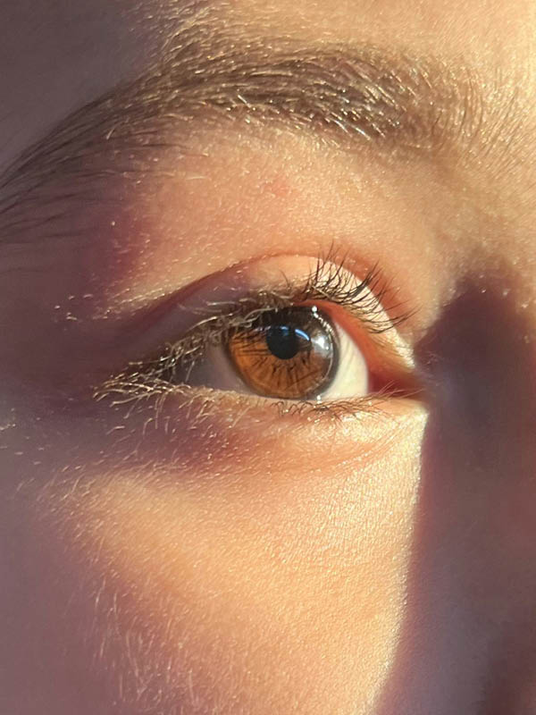 Tørre øjne, Øjenallergier øjenlågsbetændelse