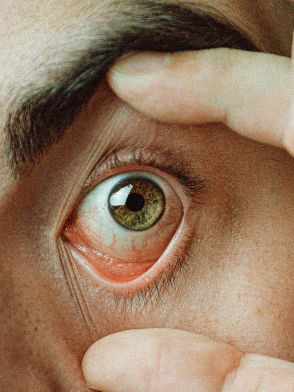 øjenlåg og tåreveje