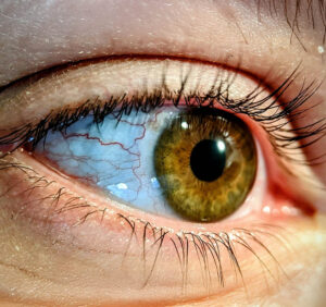 Øjenallergier behandlinger